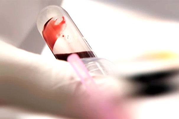 Blutentnahme für PSA-Test